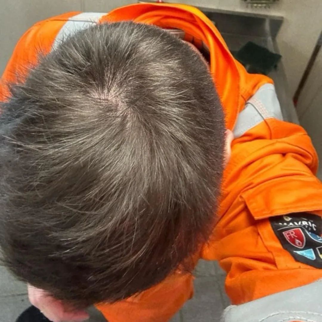 Customer photo — crown after 16 weeks of use