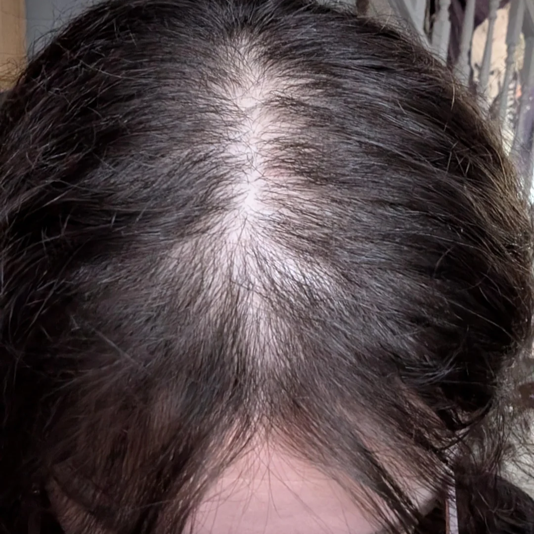 Priya's crown after 12 weeks of use