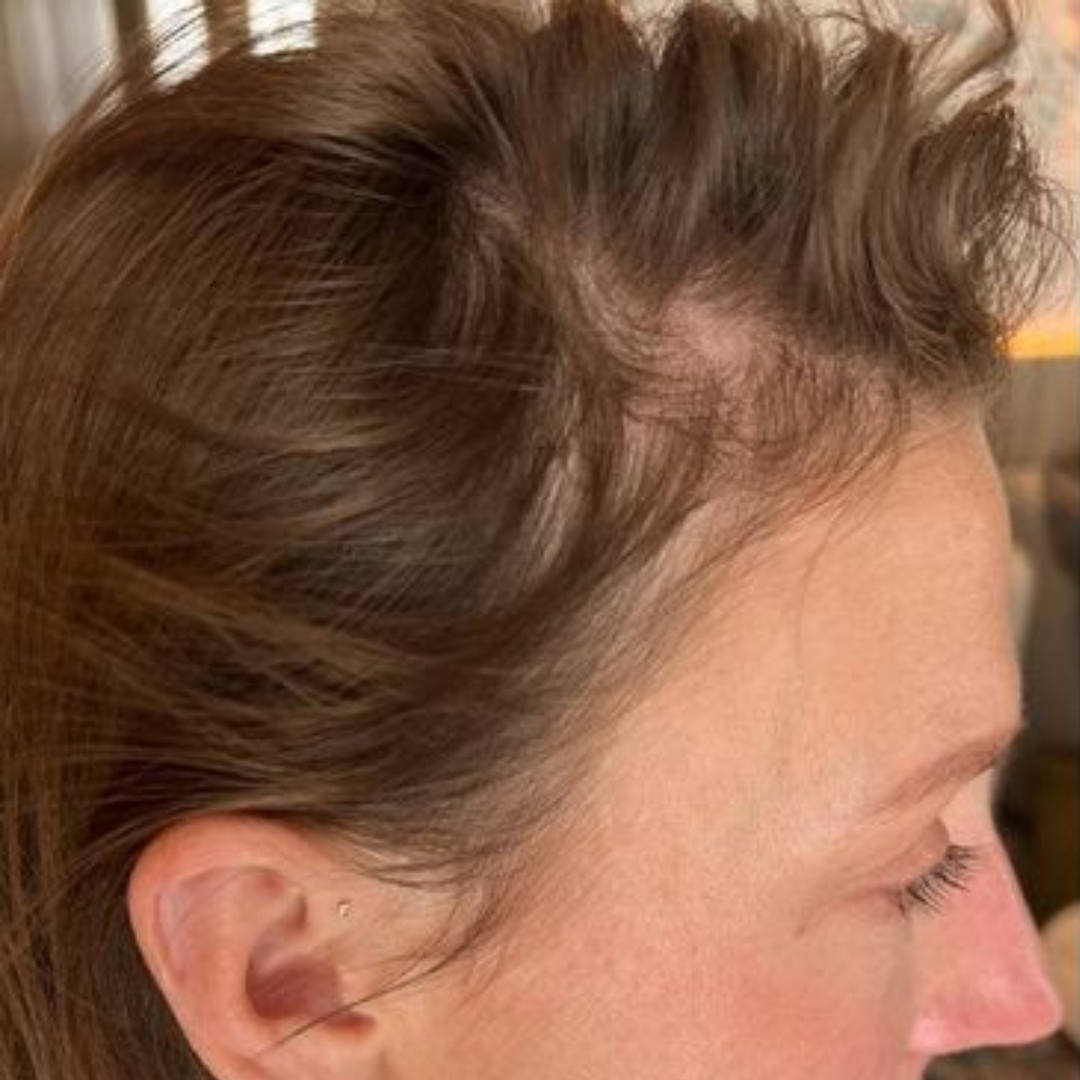 Naomi's temple and hairline before starting TREVO