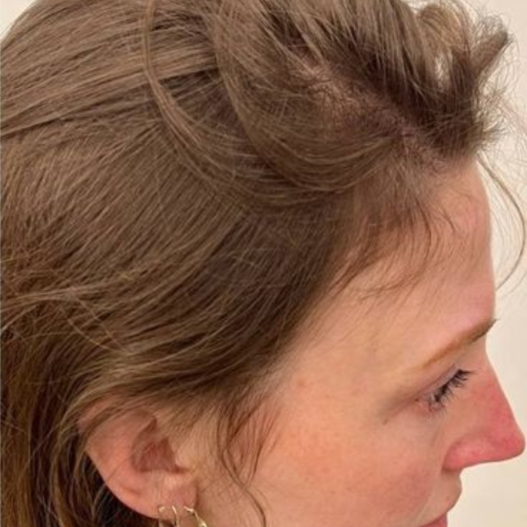 Naomi's temple and hairline after 16 weeks of use