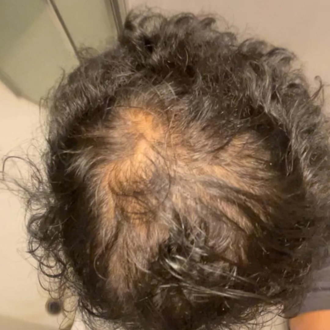 Marcus's crown before starting TREVO