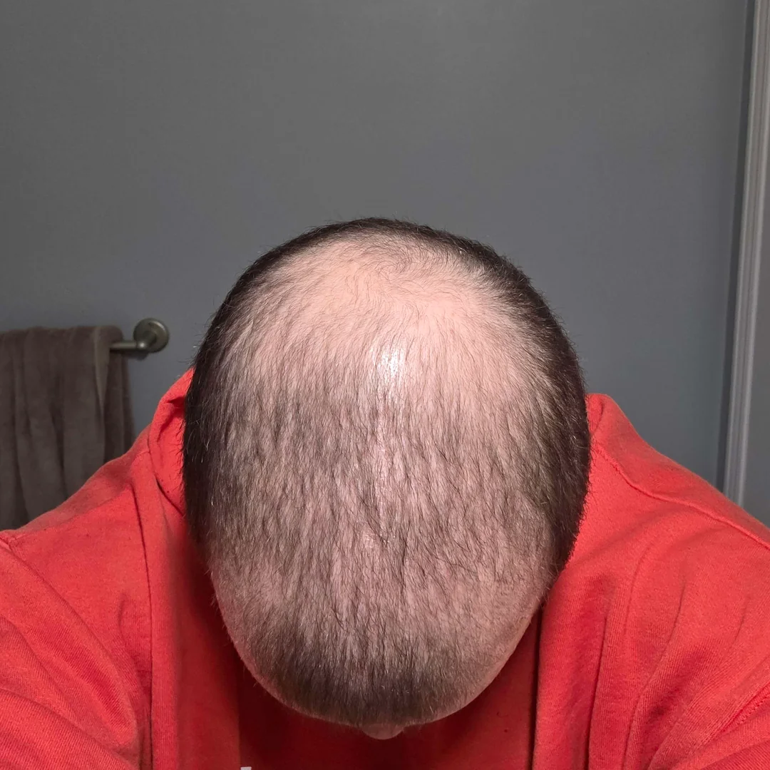 Dev's crown and temples before starting TREVO