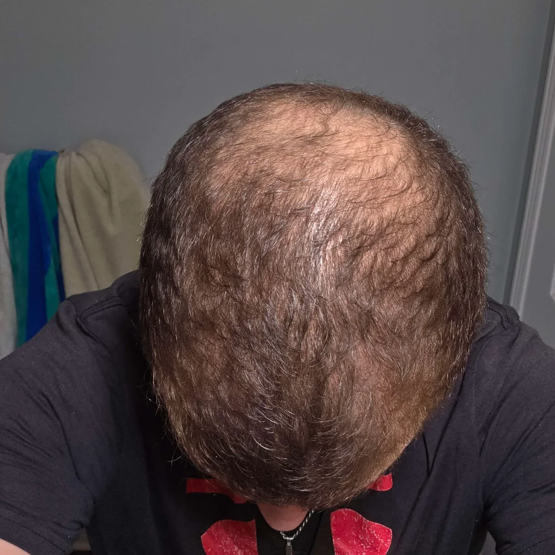 Dev's crown and temples after 24 weeks of use