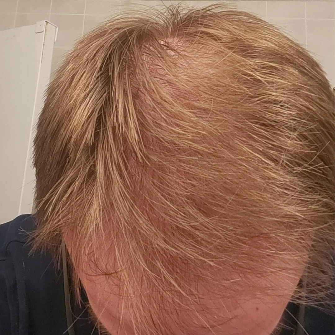 Tom's hairline before starting TREVO
