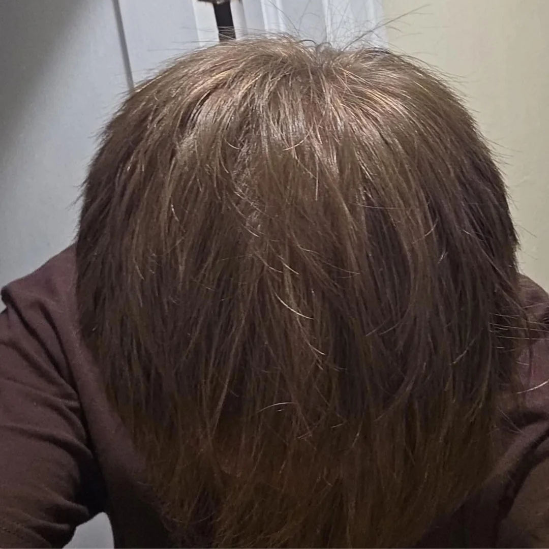 Tom's hairline after 12 weeks of use