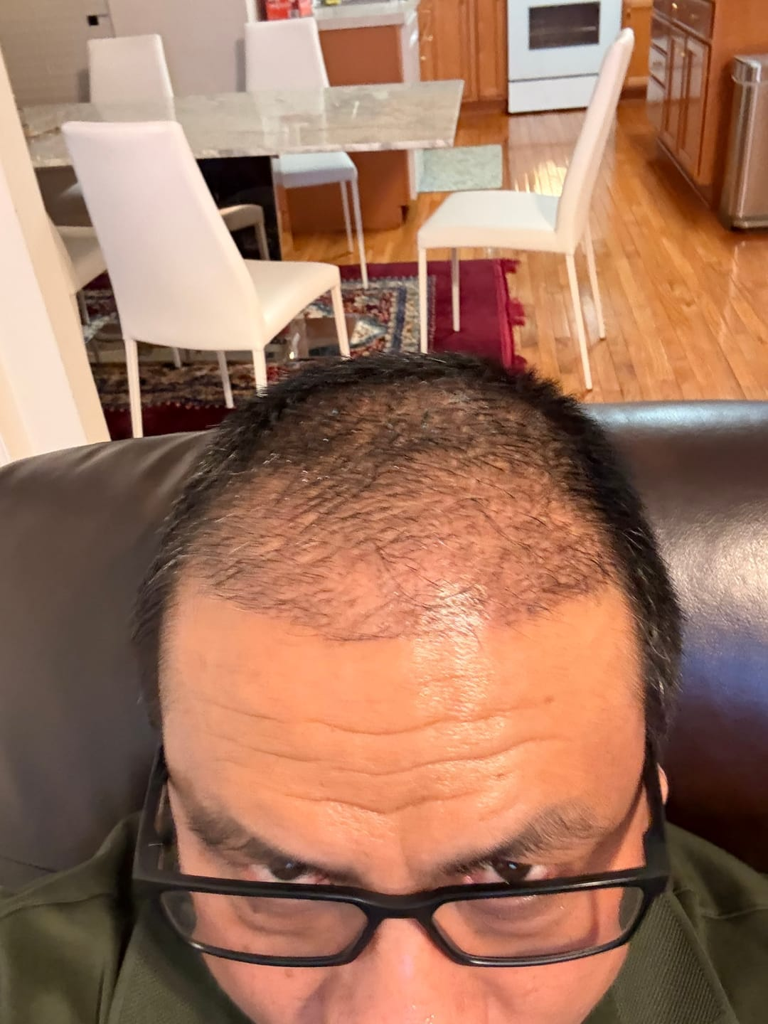 Customer photo — hairline and crown during use